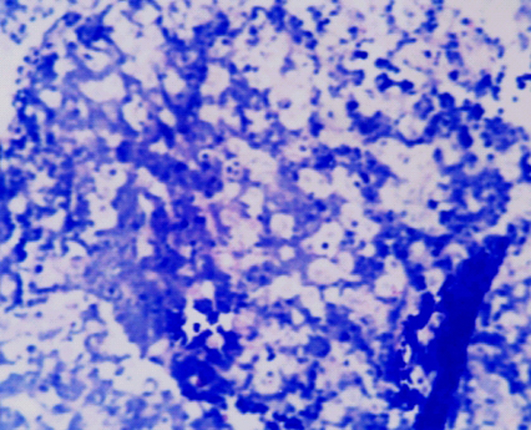 Fig.5: Linfoma de Burkitt intestinal. - <div style=